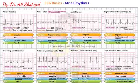 ekg state test hard|ekg test flashcards.